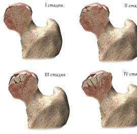 Асептичний некроз головки стегнової кістки: стадії, лікування та прогноз
