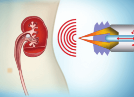 Лікування нефролітіазу: три варіанти видалення ниркових каменів