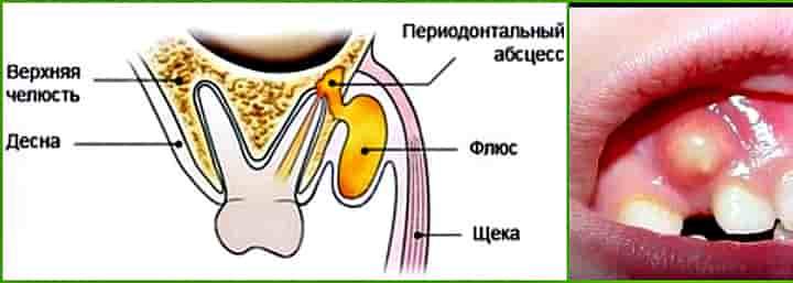 Чи небезпечний флюс на яснах і чи можна проводити лікування в домашніх умовах