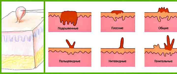 Медичне лікування папілом і народними засобами