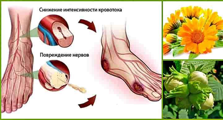 Як лікувати діабетичну нейропатію народними методами