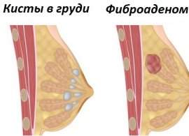 На який день менструального циклу роблять УЗД молочних залоз?