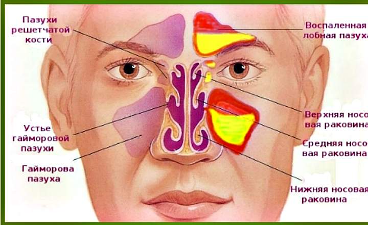 Як лікувати запалення гайморових пазух народними засобами