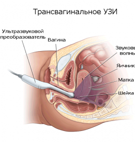 Як роблять вагінальне УЗД: підготовка, процедура і розшифровка