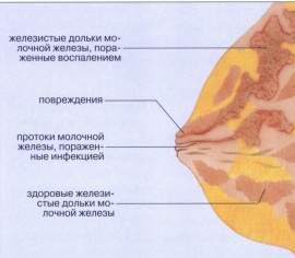 Причини виникнення лактостазу і методика лікування патолгіі