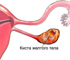 Жовте тіло в лівому яєчнику - що це значить: норма або патологія?