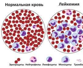 Лейкемія - що це за патологія?