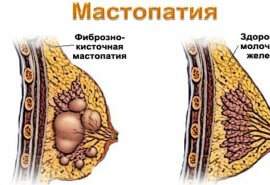 Основні ознаки фіброзно-кістозної мастопатії у жінок