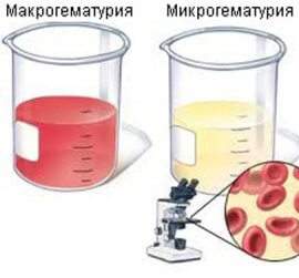 Змінені і незмінені еритроцити в сечі - що це значить?