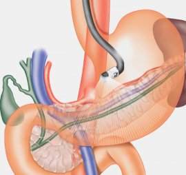Гастроскопия шлунка: підготовка, процедура, відгуки