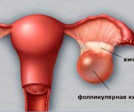 Фолікулярна кіста яєчника: основні симптоми новоутворення