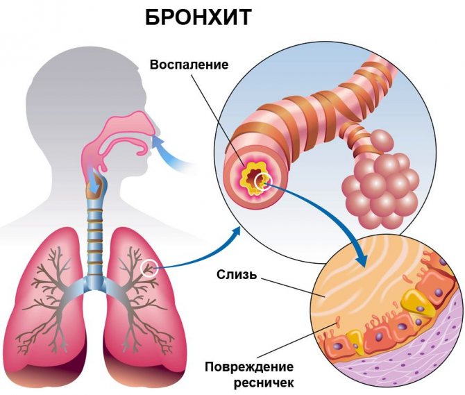 Інгаляції з мінеральною водою при нежиті та кашлю