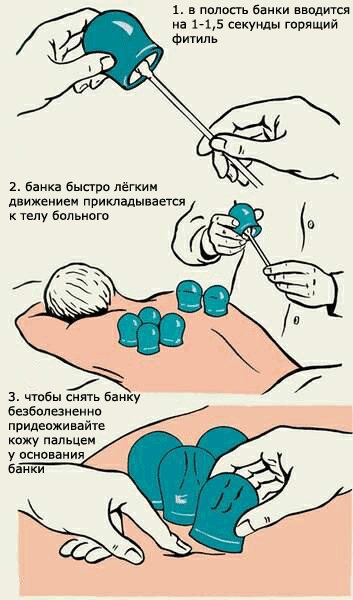 Корисні властивості банок на спину і можливий їх шкода для організму. Банки на спину: користь для здоров'я: лікування та профілактика