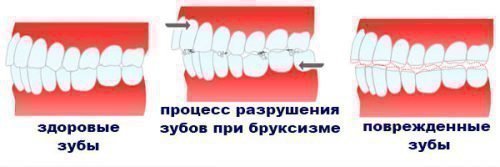 Бруксизм, скрип зубами у дітей молодшого віку