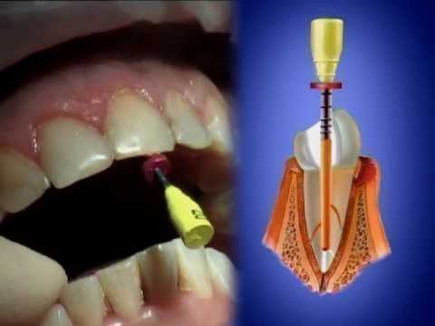 Використання Термофіли