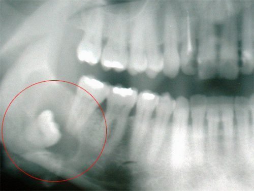 Запалилася і болить ясна близько зуба мудрості: причини і способи лікування