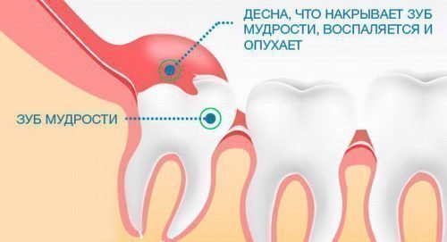 Запалилася і болить ясна близько зуба мудрості: причини і способи лікування