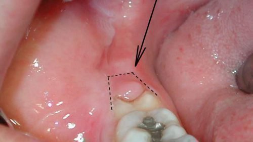Запалилася і болить ясна близько зуба мудрості: причини і способи лікування