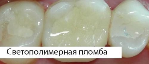 З чого роблять пломбу для зуба, склад