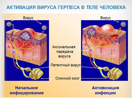 Як лікувати стоматит герпетичний мовою