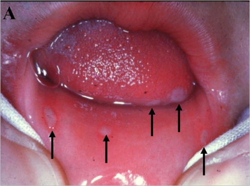 Як лікувати стоматит герпетичний мовою