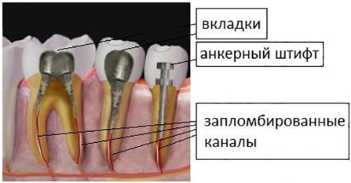 Перепломбування зубних каналів: особливості процедури