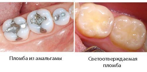 Особливості світловий пломби