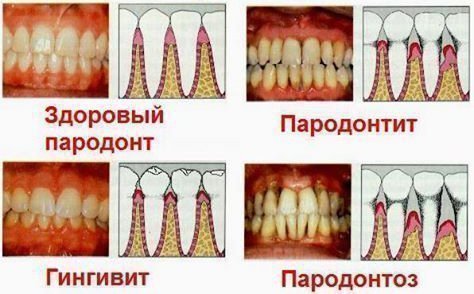 Причини хворобливих відчуттів в яснах