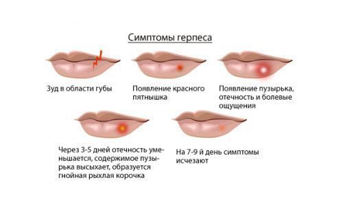 Способи боротьби з герпесом на губах