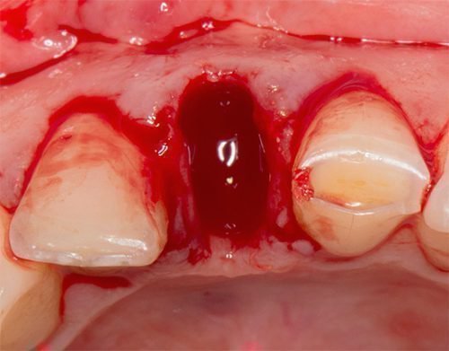 Причина кровоточивості ясен після видалення зуба