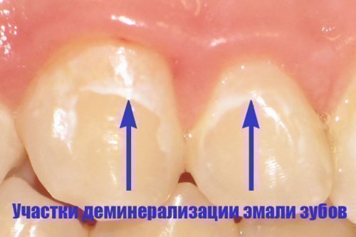 Чи безпечні брекети і псує їх носіння зубну емаль?