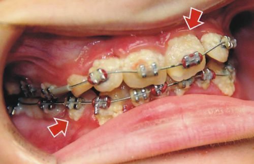 Чи безпечні брекети і псує їх носіння зубну емаль?