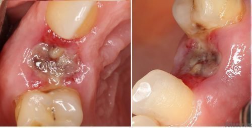 Причини білого нальоту після видалення зуба