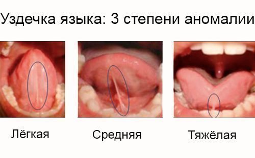 Як визначити, що у дитини анкілоглоссія (коротка вуздечка мови)