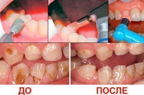 Що таке клиновидний дефект зуба