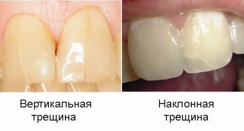 Що робити, якщо тріснула емаль на передніх зубах