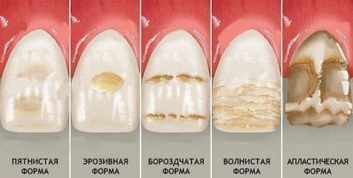 Як швидко відновлюють зубну емаль в домашніх умовах