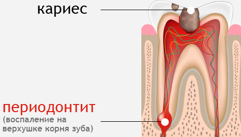 Причини хронічного гранулирующего періодонтиту