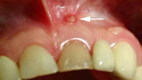 Причини і методи лікування прищика на яснах над зубом