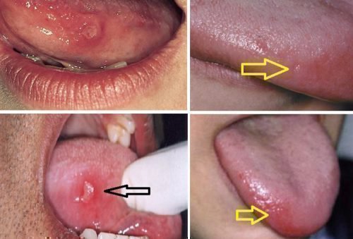Звідки з'являються болячки на тканинах мови