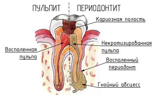 Поширені захворювання зубів: карієс, пародонтит, пульпіт