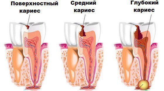 Види діагностики карієсу