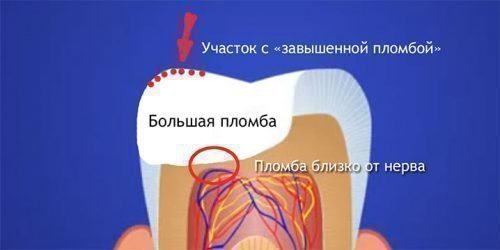 Через скільки проходить чутливість зуба після пломбування