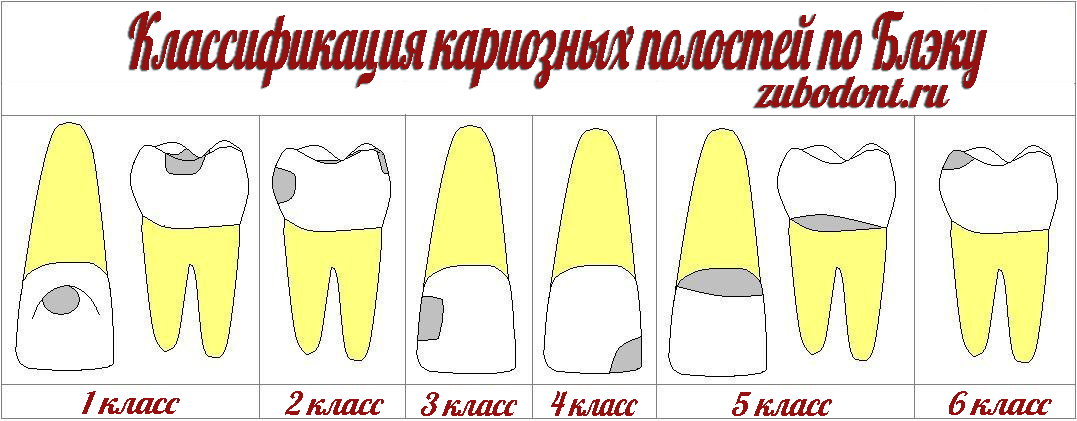 Скільки видів у карієсу