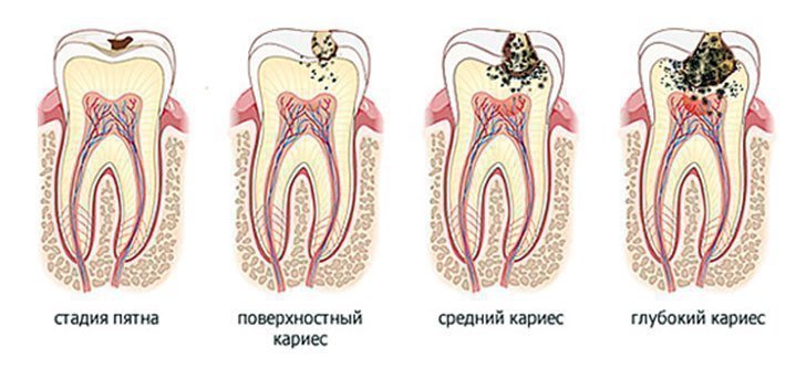 Що викликають каріозні поразки