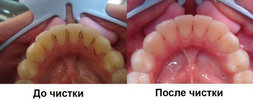 Правила профілактики пародонтиту