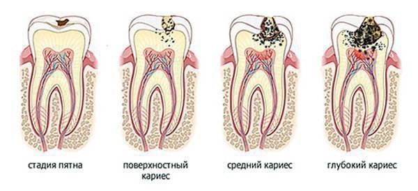 Чим небезпечний карієс, якщо його не лікувати