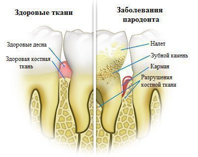 Етіологія і розвиток захворювань пародонту