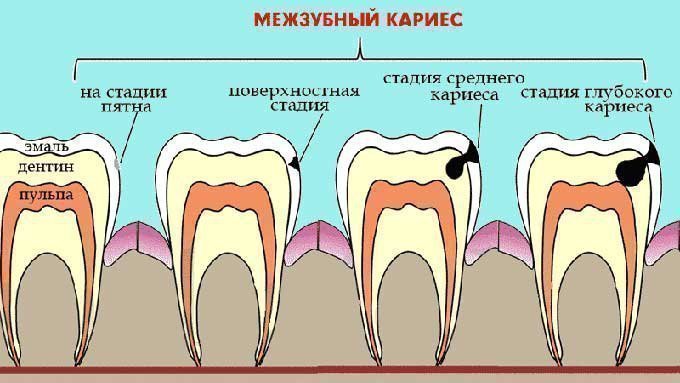 Причини і лікування карієсу між зубами