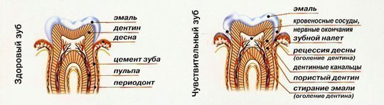 Як лікувати чутливість зубів